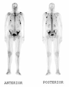 Bone Scan
