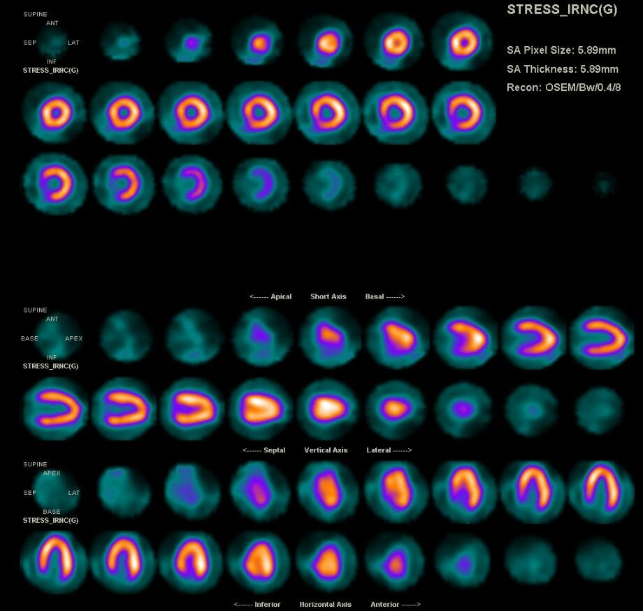 Myocardial Perfusion Image Set