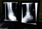 X-Ray of Joints